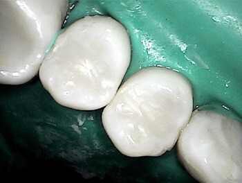 Two teeth flawlessly repaired with tooth-colored fillings