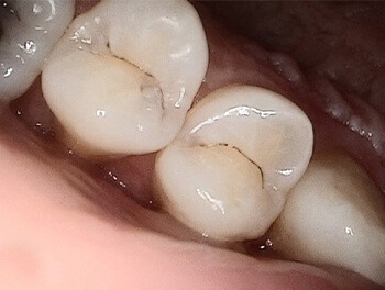 Two damaged teeth before dental care