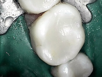 Tooth with natural looking tooth colored fillings