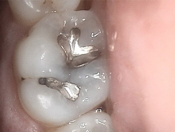Tooth with metal fillings