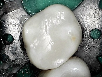 Tooth restored with conservative tooth colored fillings