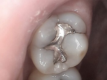 Tooth with large metal filling