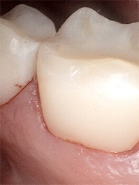 Tooth flawlessly repaired