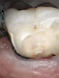 Severely decayed and damaged teeth