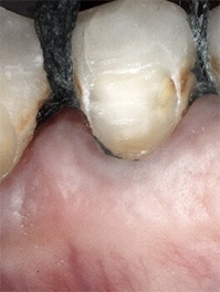 Decayed teeth and receding gums