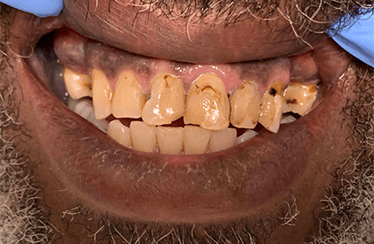 Decayed teeth and receding gums