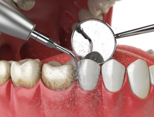 Animated smile during gum disease treatment