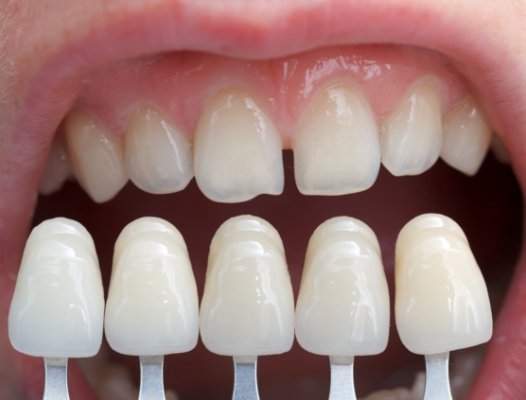 Smile compared with porcelain veneer samples
