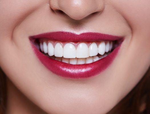 Flawless smile after gum recontouring