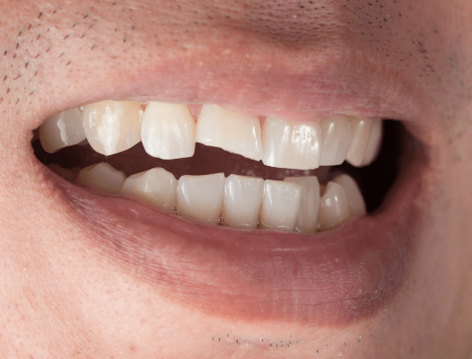 Damaged smile before dental bonding