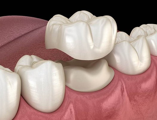 Model smile with two dental crown restorations