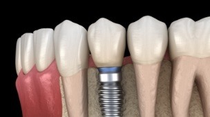 Animated smile with dental implant retained dental crown