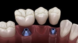 Animated smile with dental implant supported fixed bridge