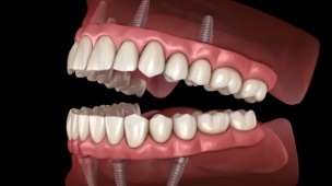 Animated smile with dental implant supported dentures