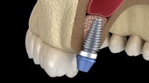 Animated smile with several missing teeth and dental implant post in place