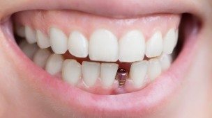 Smile with single dental implant post visible