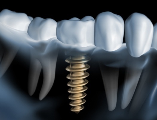 Animated smile with dental implant supported replacement tooth