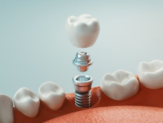 Animated parts of the dental implant tooth replacement process