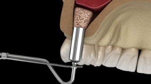 Animated smile during dental implant osseointegration