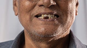 a man with multiple missing teeth
