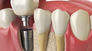 a computer illustration depicting a dental implant