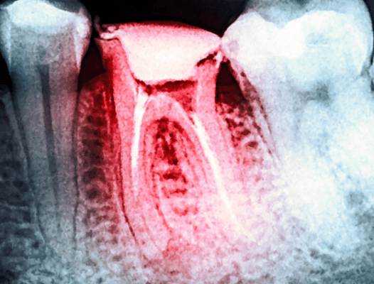 X-ray of damaged tooth before tooth extraction