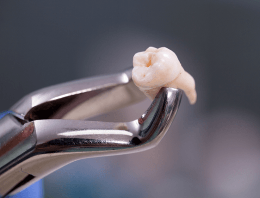 Metal clasp holding an extracted tooth