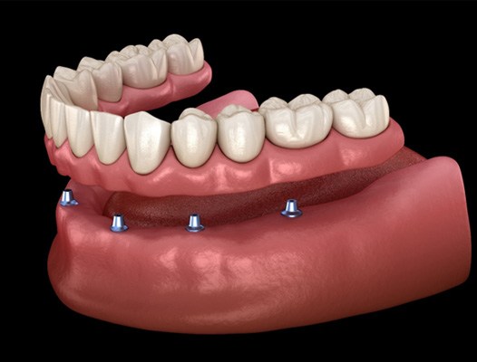 Implant dentures in D