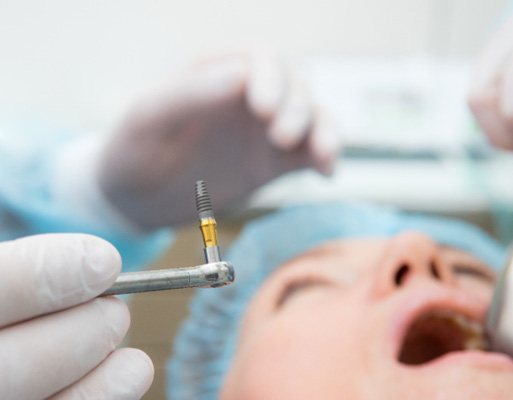 Dental implant surgery in DuPont