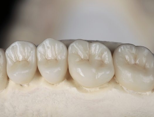 Model smile with metal free dental restorations