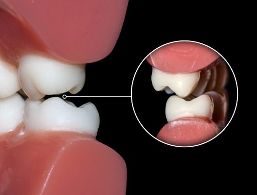 Animates smile demonstrating teeth grinding