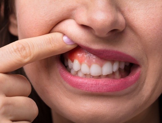 Woman with red sore on her gums indicating oral cancer