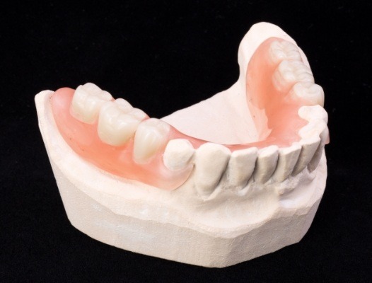 Model smile with partial denture