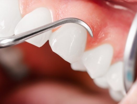 Closeup of smile during periodontal therapy