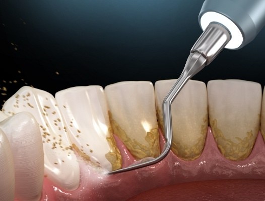 Animated smile during periodontal therapy