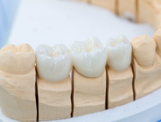 Model smile with dental crown supported fixed bridge restoration