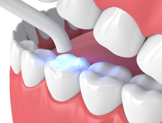 Animated smile during dental sealant placement