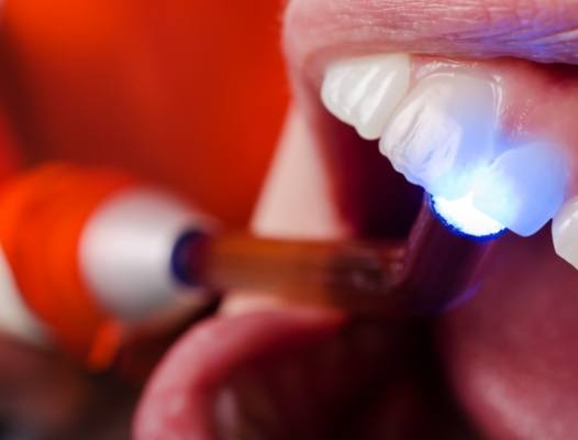 Closeup of smile during dental sealant placement