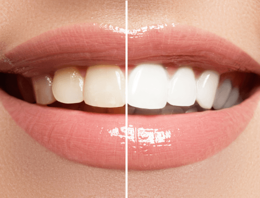 Smile before and after teeth whitening