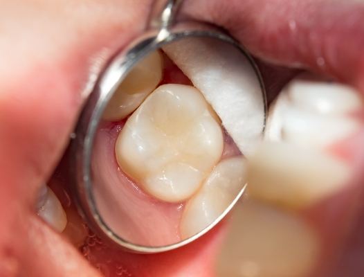 Closeup of smile repaired with tooth colored fillings