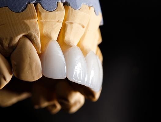 a model of a mouth with veneers on teeth