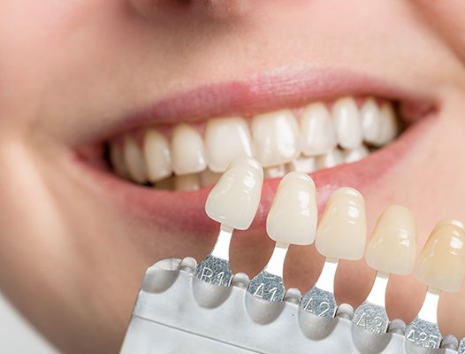 a smile with a dental shade chart in front of it