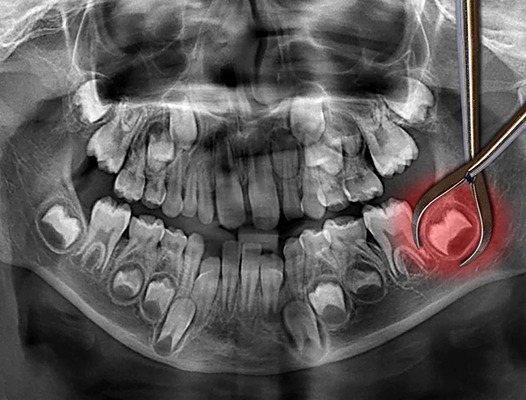 Wisdom tooth extractions in DuPont