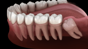 Animated smile with crowded teeth
