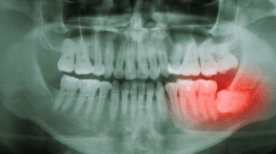 X-ray of smile with impacted wisdom tooth