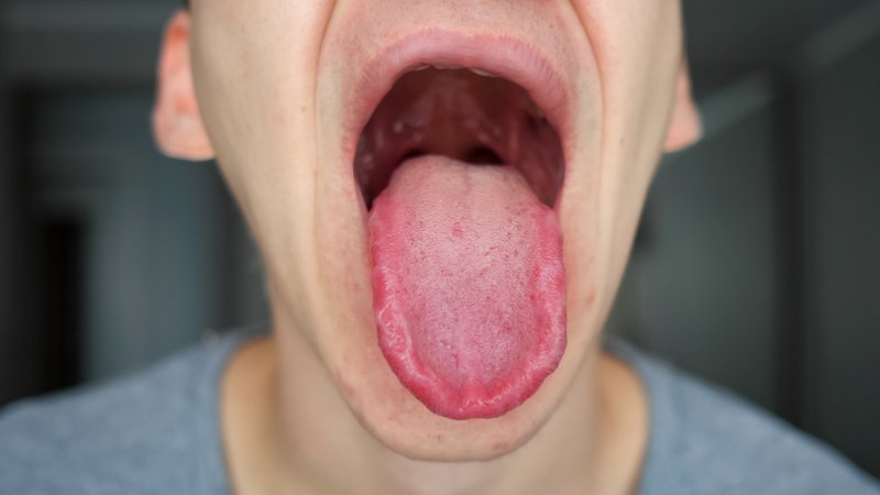 What dental teams need to know about scarlet fever