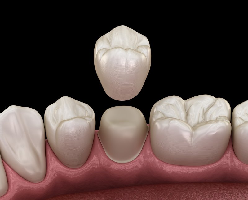 When Is A Dental Crown Needed in DuPont | Dupont Family Dentistry