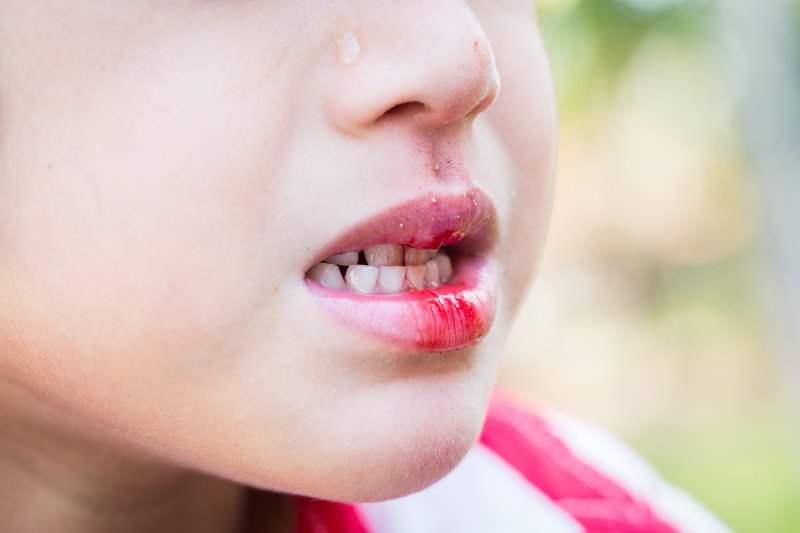 a child with a bloodied lip caused by a dental emergency 