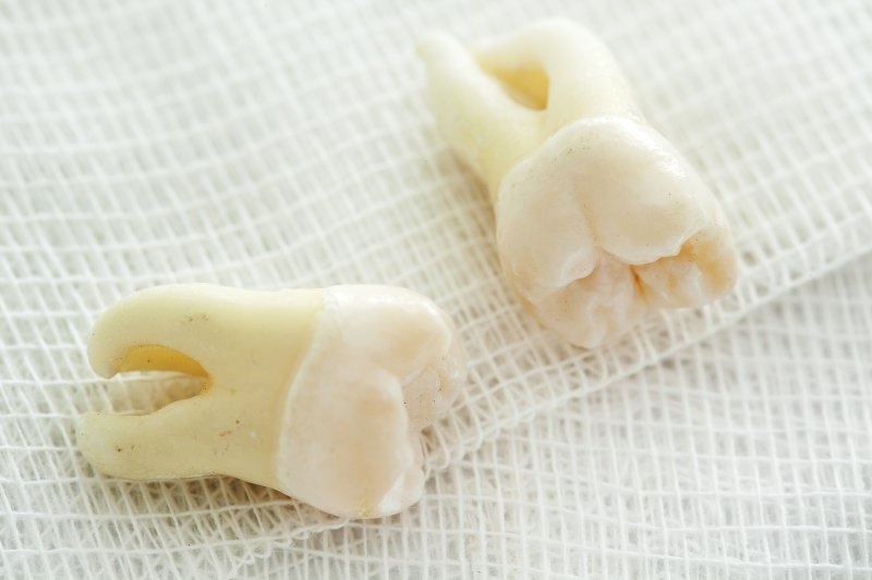 two wisdom teeth lying on a bed of surgical gauze after being extracted