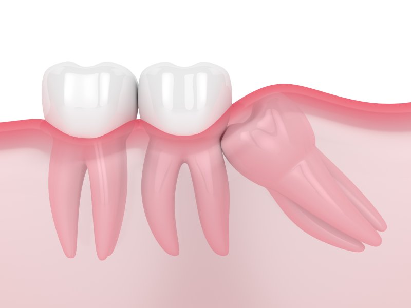 a digital image of an impacted wisdom tooth pressing against healthy teeth on the lower arch